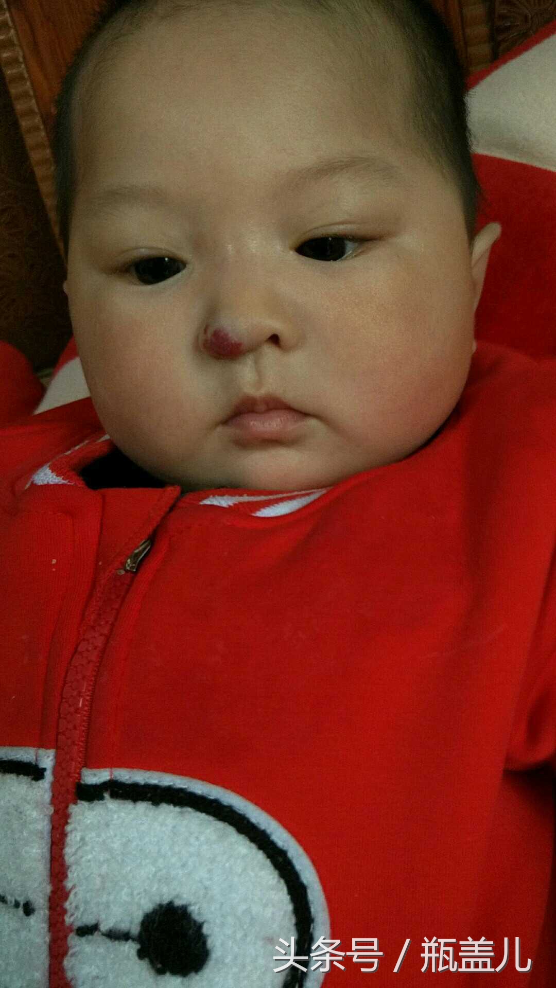 宝宝鼻子上的血管瘤怎么办,宝宝鼻子上长血管瘤怎么治
