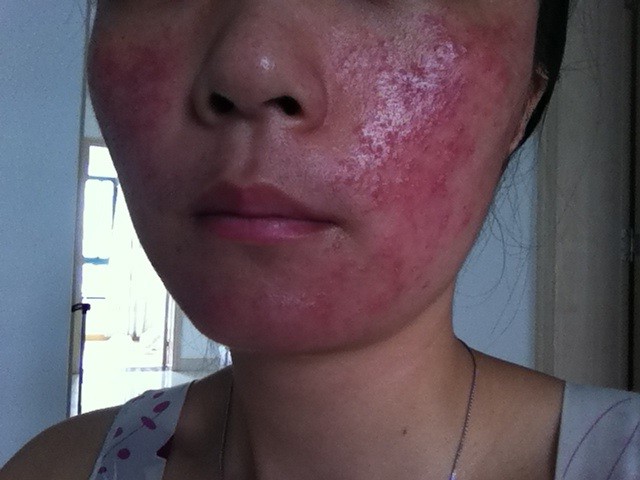激素脸修复期间脸红烫更厉害,红烫型激素脸