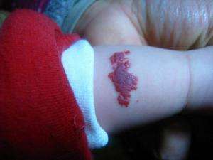 蔓状血管瘤是瘤还是血管畸形,混合血管瘤和血管畸形的区别