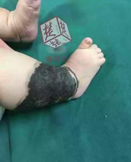 女宝小腿上有颗痣代表什么,女童小腿上长了黑痣