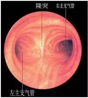 周围型肺癌病理分期,肺癌分期以病理为准还是以ct为准