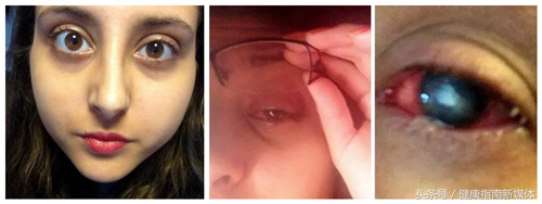 英国妹子用失明的教训告诉你，千万别让隐形眼镜沾上水