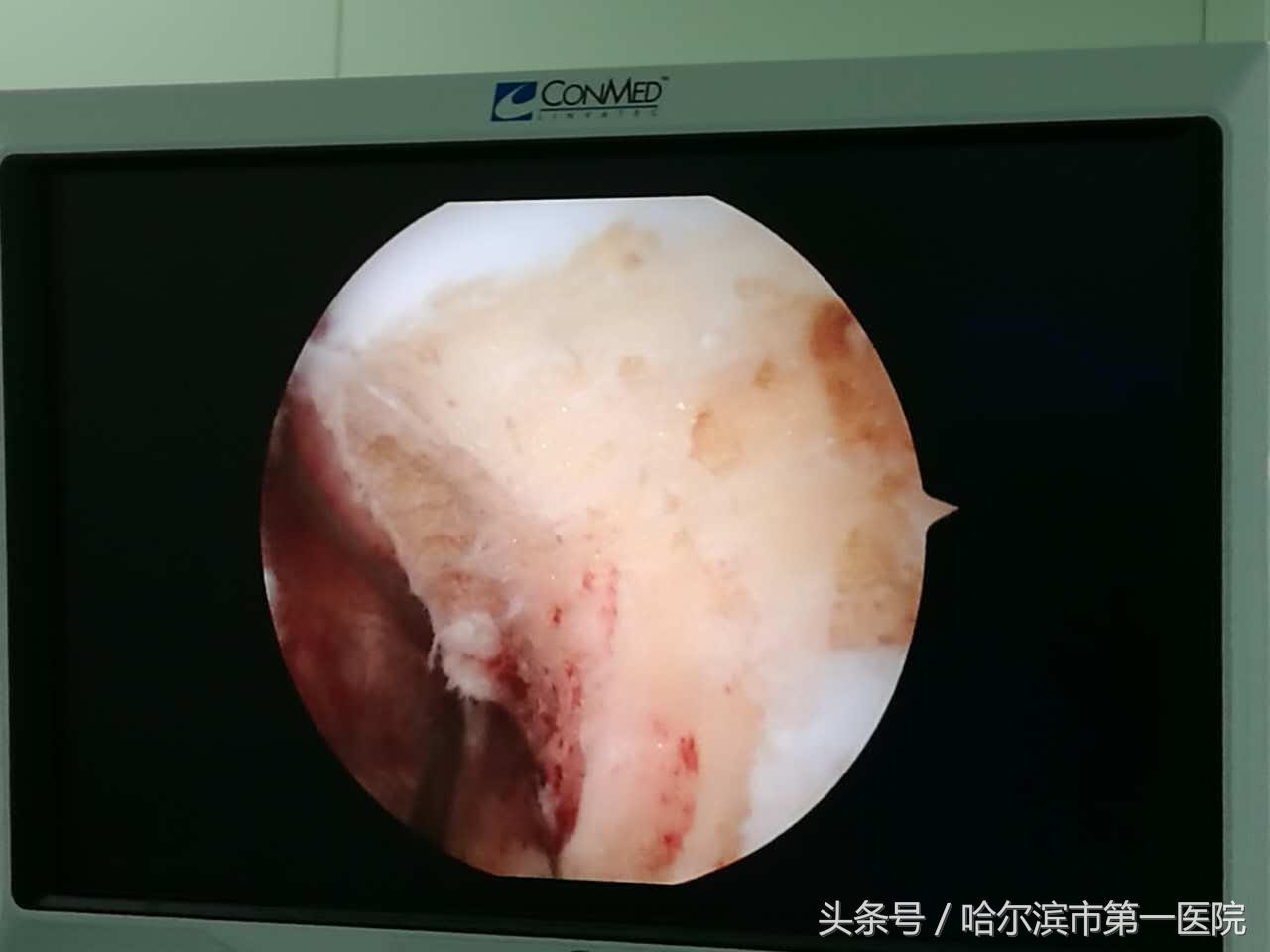 走路胯疼最快缓解方法,走路胯骨响怎么纠正