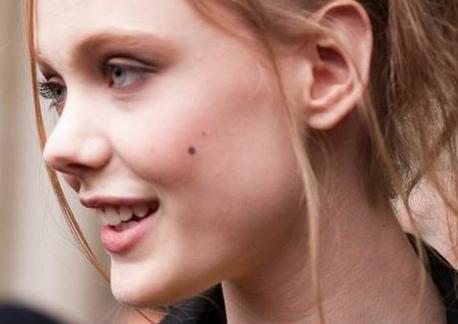 脸上有痣很难看要不要去点掉呢,脸上痣变美