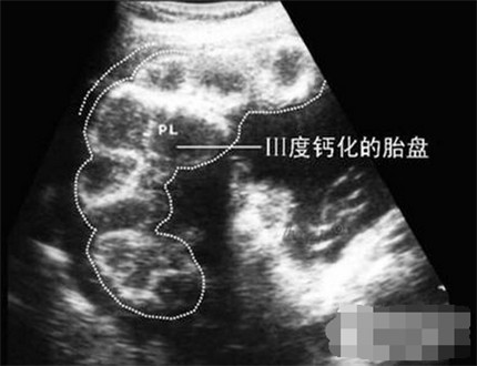 吃钙片会引起胎盘老化吗,吃钙片会加重胎盘成熟度吗