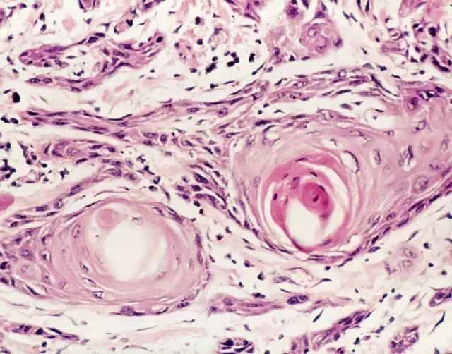 关于舌癌的新闻又一次刷屏，我想起了一年前离开的那位老人