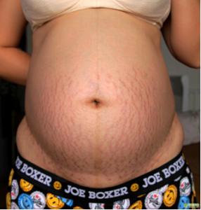 妊娠纹怎么能消除,妊娠纹怎么消除啊