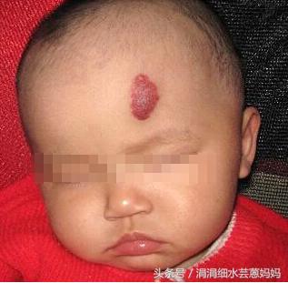 小孩胳膊有黑白花斑,小孩有一块血斑