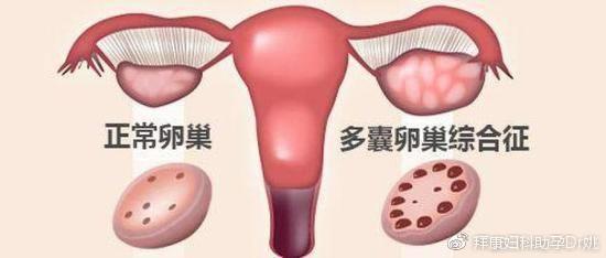 妇科内分泌紊乱之PCOS篇