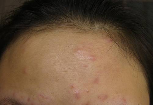 额头长痘的最佳解决办法,鼻子和额头长痘怎么回事