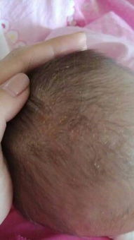 新手妈妈来围观：新生儿“胎毒”“胎垢”和胎脂到底该不该清除？