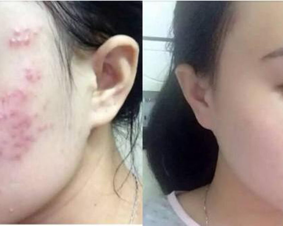 脸颊两侧长痘用什么药膏,脸颊两侧长痘中医怎么说