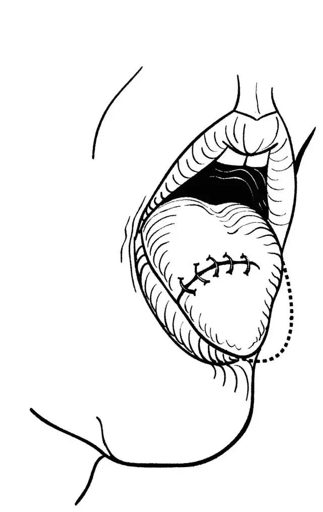 关于舌癌的新闻又一次刷屏，我想起了一年前离开的那位老人