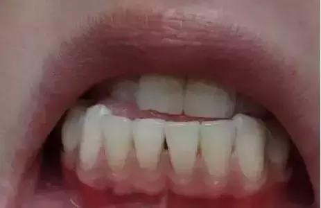 年纪轻轻牙龈萎缩牙齿松动,年纪轻轻牙龈萎缩