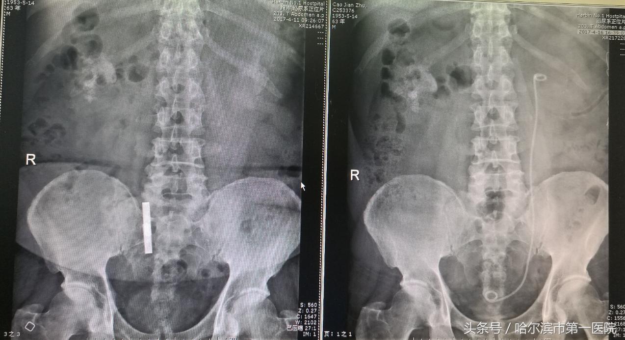 结石像鹿角占满左肾 哈市一院泌外专家半小时成功取出