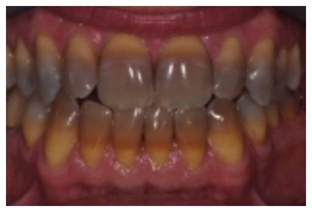 牙越来越黑是什么原因,牙为什么会黄或黑