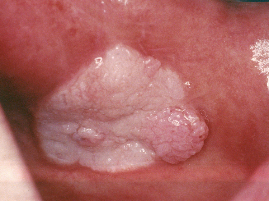 关于舌癌的新闻又一次刷屏，我想起了一年前离开的那位老人