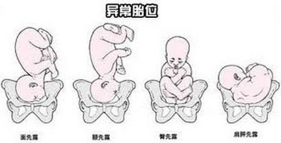 异常胎位纠正视频,异常胎位是怎么导致的
