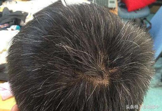 白头发长在头顶是什么原因,白头发长在两鬓是什么原因