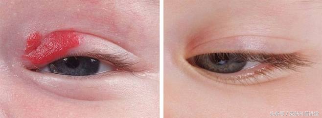 普萘洛尔治疗婴幼儿血管瘤的原因,普萘洛尔治疗血管瘤的关注事项