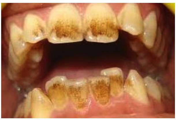 牙越来越黑是什么原因,牙为什么会黄或黑