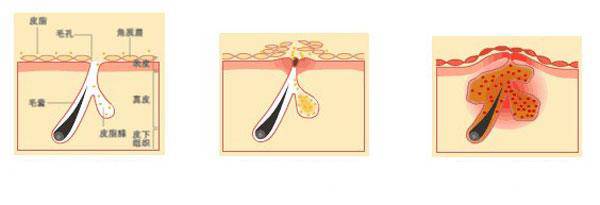 额头长痘的最佳解决办法,鼻子和额头长痘怎么回事