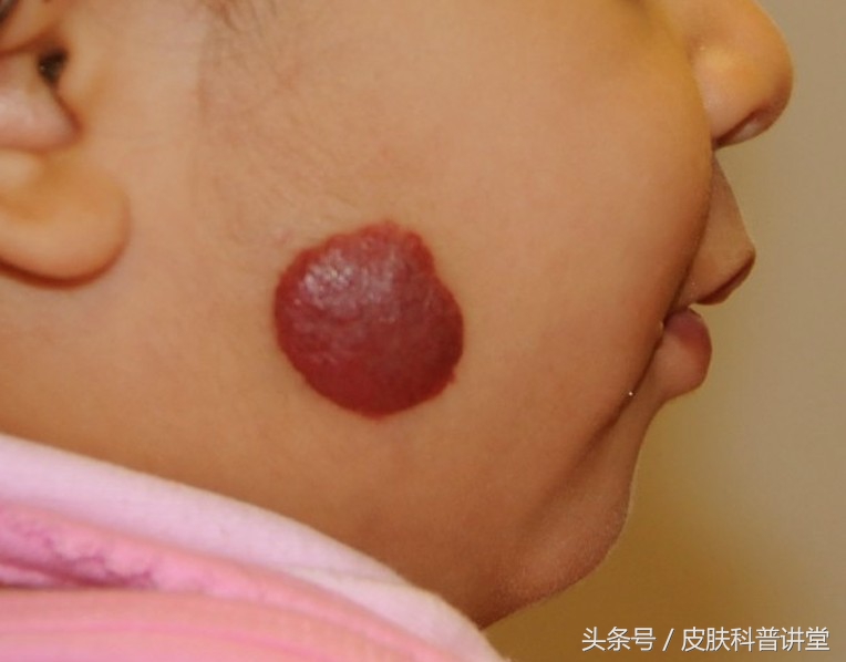 普萘洛尔治疗婴幼儿血管瘤的原因,普萘洛尔治疗血管瘤的关注事项