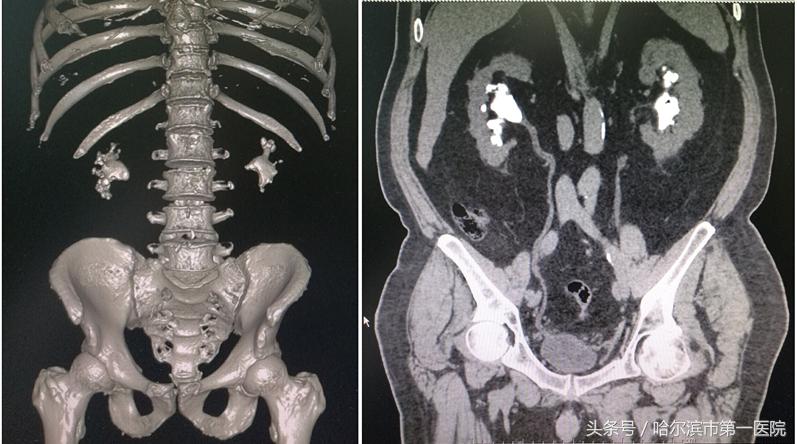 结石像鹿角占满左肾 哈市一院泌外专家半小时成功取出