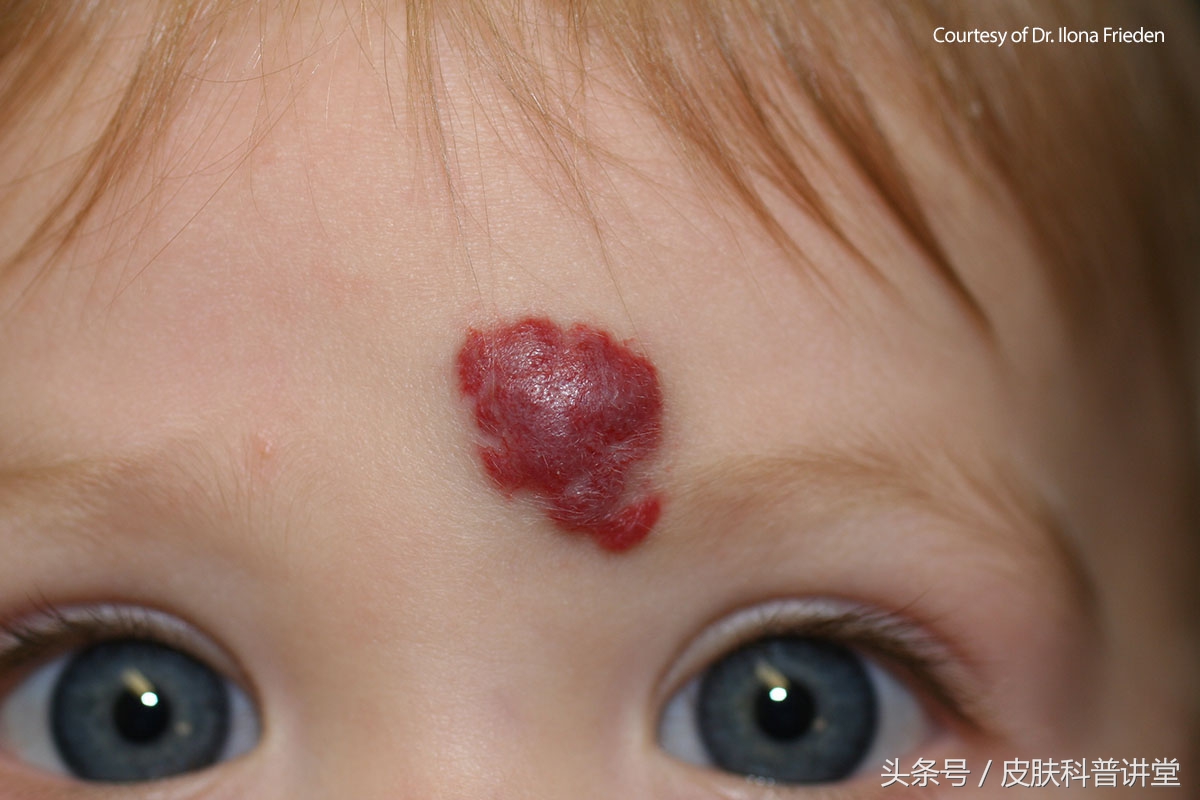 普萘洛尔治疗婴幼儿血管瘤的原因,普萘洛尔治疗血管瘤的关注事项