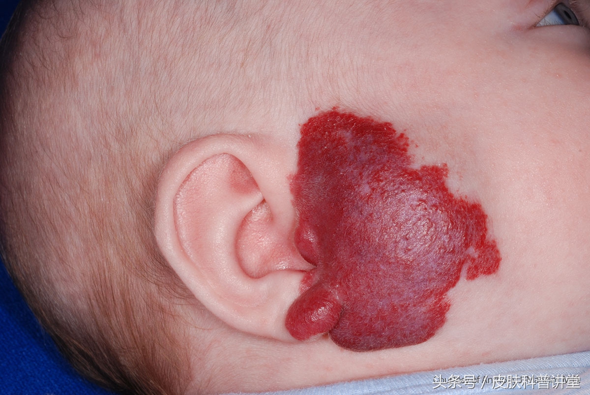 普萘洛尔治疗婴幼儿血管瘤的原因,普萘洛尔治疗血管瘤的关注事项