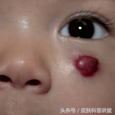 普萘洛尔治疗婴幼儿血管瘤的原因,普萘洛尔治疗血管瘤的关注事项