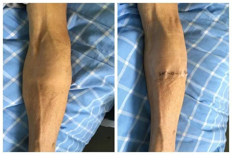 造影剂外渗如何处理,做cta时造影剂外渗怎么办