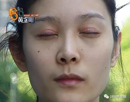 姑娘*款贷**八万在杭州整形没效果医院：术后她就喝酒化妆