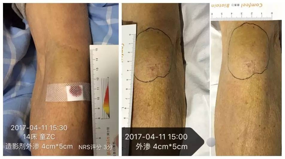 造影剂外渗如何处理,做cta时造影剂外渗怎么办