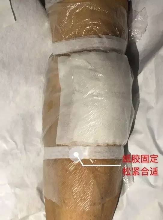 造影剂外渗如何处理,做cta时造影剂外渗怎么办