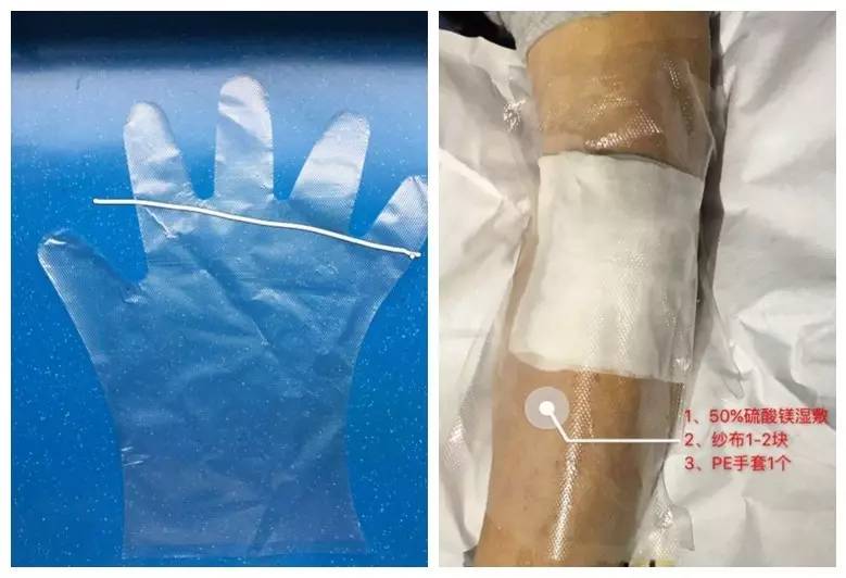 造影剂外渗如何处理,做cta时造影剂外渗怎么办