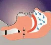 打鼾猝死几率高不高,打鼾致憋气停止怎么治疗