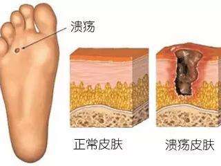 糖尿病足溃烂怎么治疗好得快,糖尿病足溃烂了一般怎么治疗