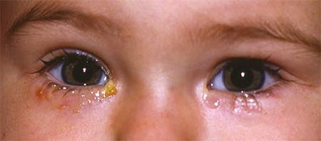 濠村効榧绘唱绠′笉閫氭墜鏈湁鍚庨仐鐥囧悧,榧绘唱绠′笉閫氭墜鏈灏戦挶