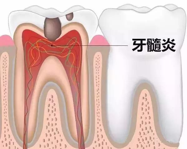 让人爱恨两难的根管治疗