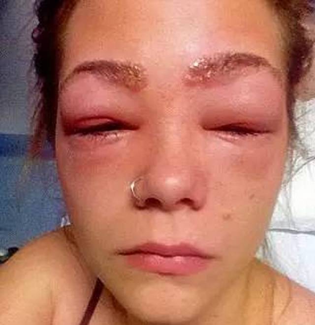 美女在家染眉毛，结果双眼肿得吓人！代价太大了！