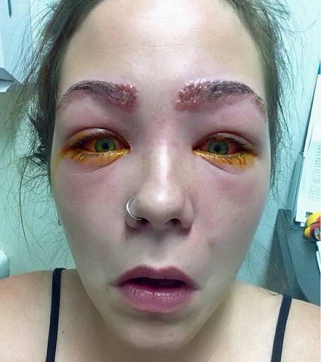 美女在家染眉毛，结果双眼肿得吓人！代价太大了！