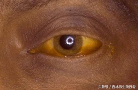 乙肝怎样预防肝癌发生,乙肝怎么预防肝癌的发生