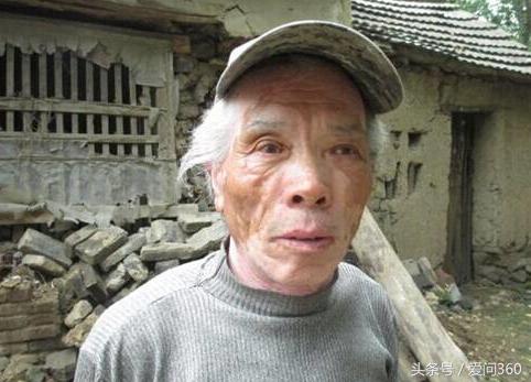 60岁皮肤有白斑怎么办,60岁白斑怎么治疗