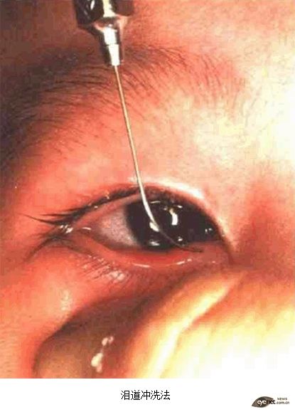 濠村効榧绘唱绠′笉閫氭墜鏈湁鍚庨仐鐥囧悧,榧绘唱绠′笉閫氭墜鏈灏戦挶