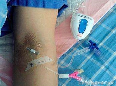 肺癌化疗最好用哪种化疗药物,化疗治疗癌症的原理