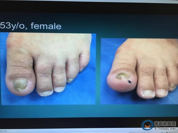 她脚趾甲卷成「吸管」状竟不是灰指甲在搞怪