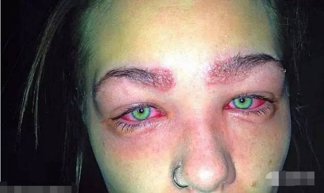 美女在家染眉毛，结果双眼肿得吓人！代价太大了！