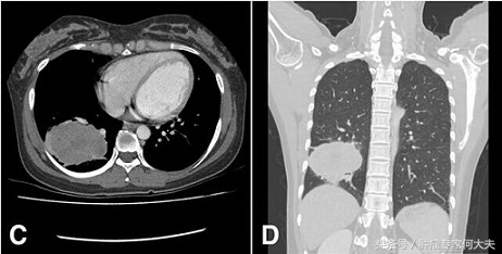 得了肺癌没钱治怎么办,家境贫寒如何选择肺癌晚期治疗