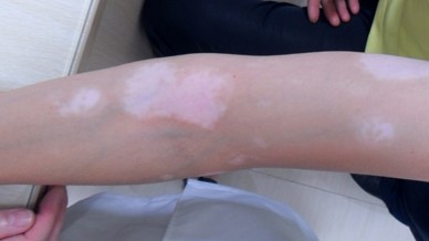 手上长白斑早期怎么预防,预防外阴白斑复发的方法是什么